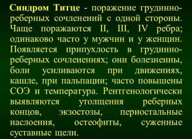 Синдром Титце. Симптомы, причины и лечение