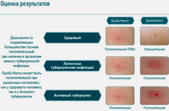 Синяк на месте Диаскинтеста после прививки это норма? Фото