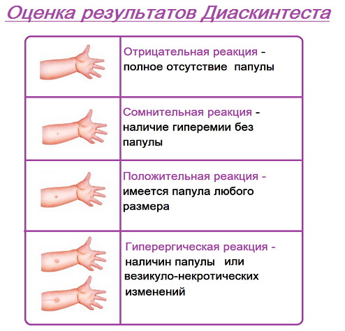 Синяк на месте Диаскинтеста после прививки это норма? Фото