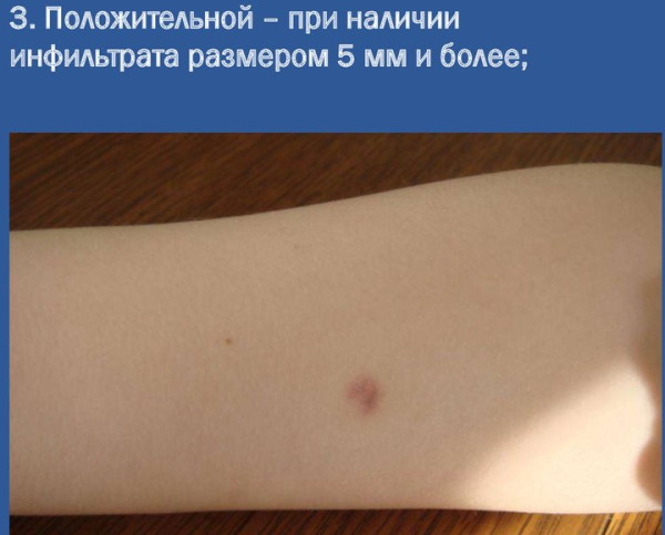 Синяк на месте Диаскинтеста после прививки это норма? Фото