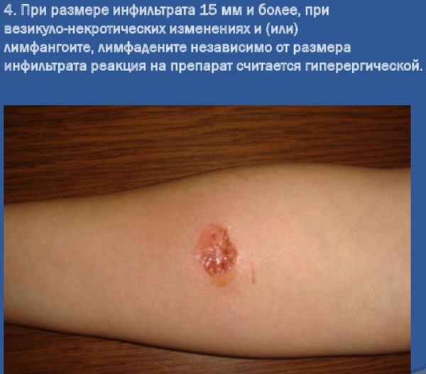 Синяк на месте Диаскинтеста после прививки это норма? Фото