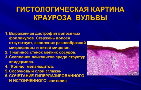 Склероатрофический лихен у девочек, женщин. Народные средства, препараты