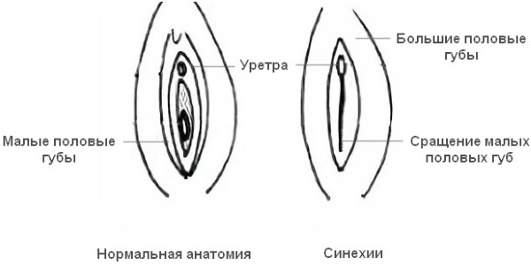 Склероатрофический лихен у девочек, женщин. Народные средства, препараты