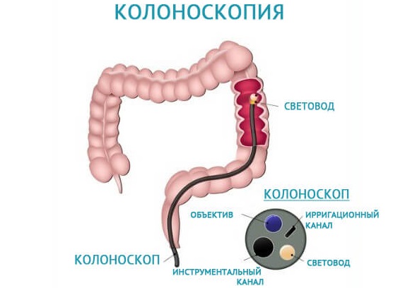 Спайки кишечника. Симптомы и лечение, народные средства, препараты, диета, упражнения