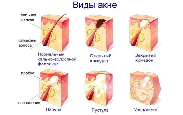 Средства от прыщей для подростков на лице: медикаментозные, косметические, народные