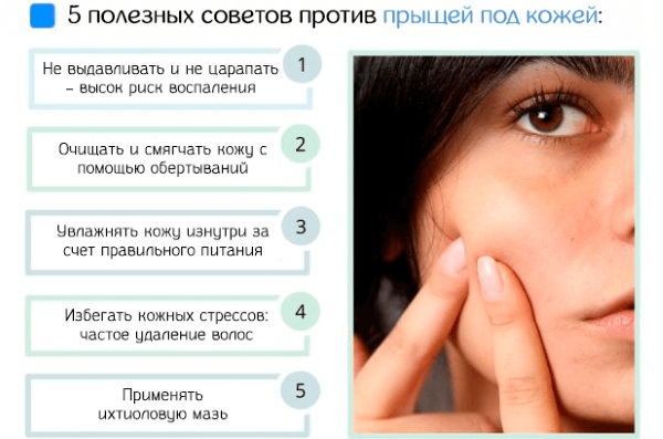 Средства от прыщей для подростков на лице: медикаментозные, косметические, народные