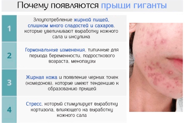Средства от прыщей для подростков на лице: медикаментозные, косметические, народные