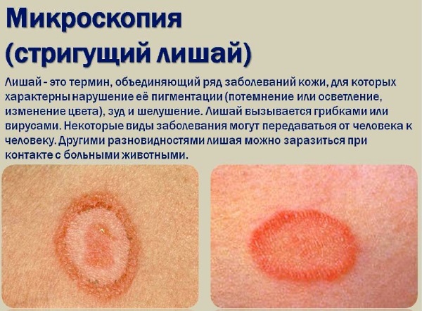 Стригущий лишай у человека. Фото, признаки, стадии, лечение народными средствами, препараты