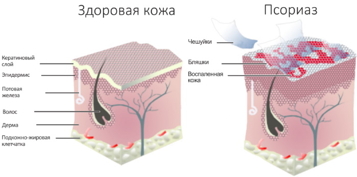 Эффективные таблетки от псориаза. Список, особенности применения, цены
