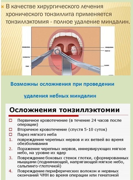 Удаление миндалин. Отзывы и последствия взрослым, детям