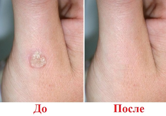 Ляписный карандаш от папиллом. Инструкция по применению, цена, отзывы