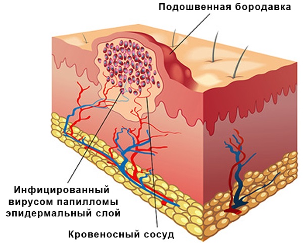 Ляписный карандаш от папиллом. Инструкция по применению, цена, отзывы