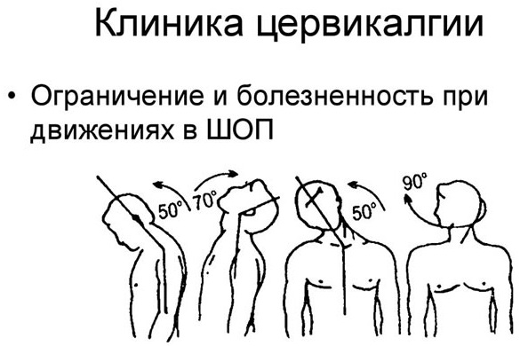 Вертеброгенная цервикалгия. Что это, как лечить с мышечно-тоническим, миофасциальным, болевым синдромом
