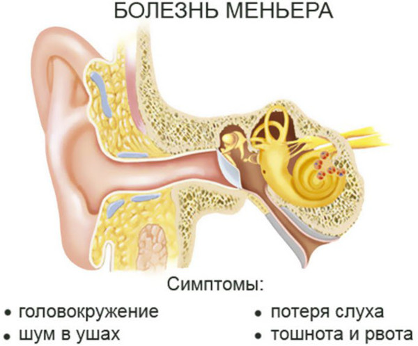 Вестибулопатия. Что это такое, симптомы, лечение: периферическая