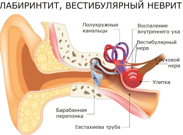 Вестибулопатия. Что это такое, симптомы, лечение: периферическая