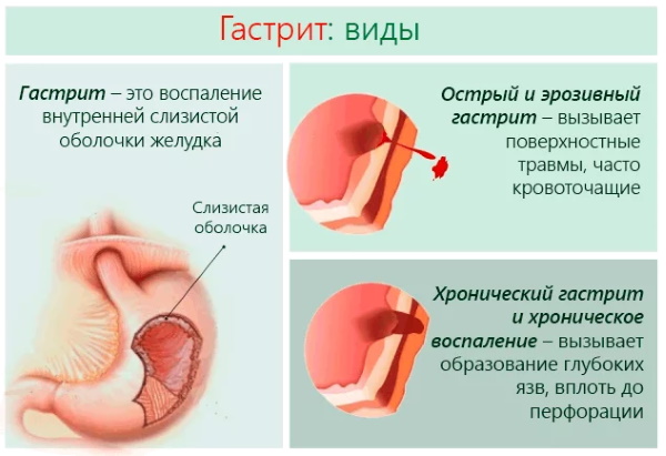 Н2 блокаторы гистаминовых рецепторов. Список препаратов, механизм действия