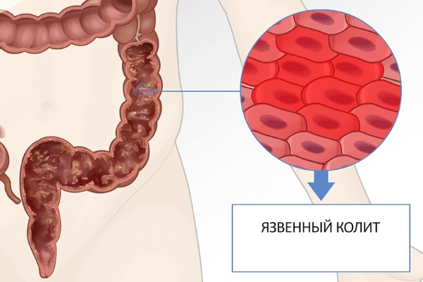 Воспаление кишечника. Симптомы и лечение. Народные средства, препараты, диета