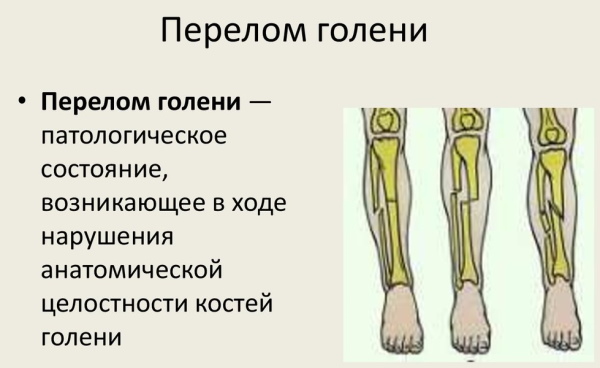 Воспаление надкостницы голени при беге. Лечение