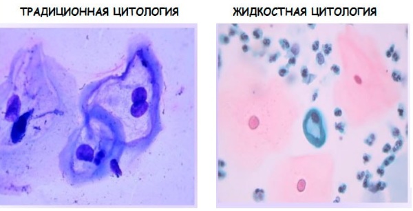 Жидкостная цитология шейки матки. Что это такое, расшифровка результатов, таблица, как берется, что показывает