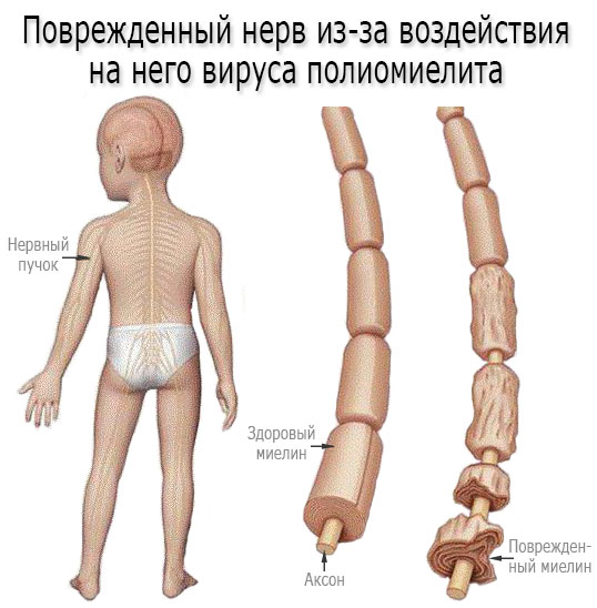 Живая аттенуированная вакцина. Что это такое, что значит, содержит против краснухи, кори, паротита, оспы, гепатита