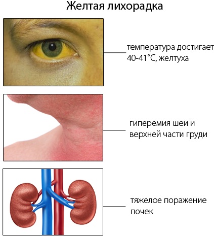 Живая аттенуированная вакцина. Что это такое, что значит, содержит против краснухи, кори, паротита, оспы, гепатита