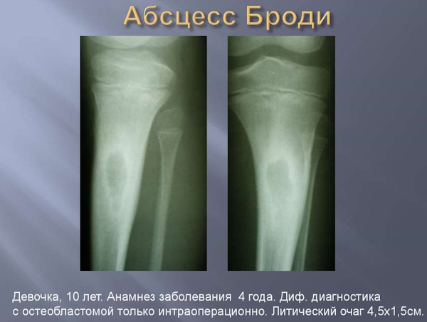 Абсцесс Броди бедренной кости большеберцовой. Что это, лечение
