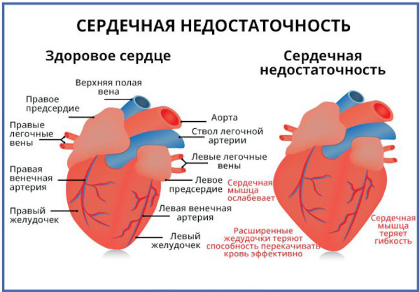Аджови (Ajovy) от мигрени. Инструкция по применению, цена, отзывы