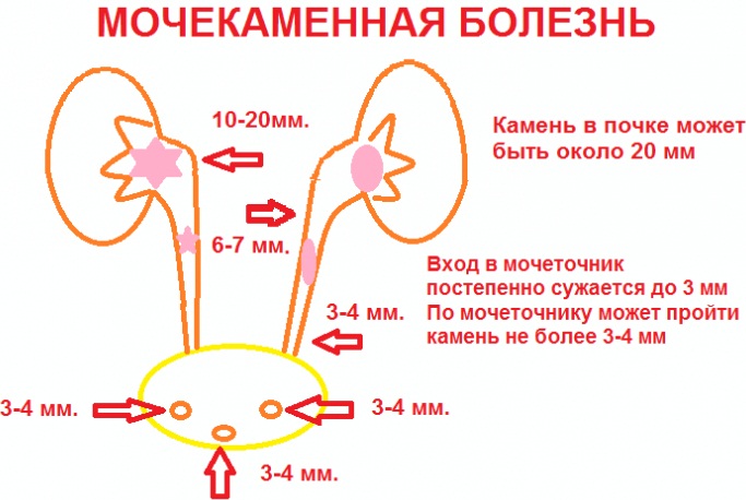 Боли в мочевом пузыре у женщин. Симптомы и лечение