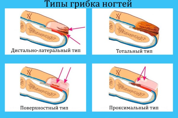 «Аморолфин» - лак для лечения грибка ногтей. Инструкция по применению, отзывы, цена