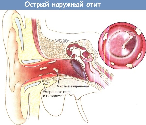 Тяжесть в голове и закладывает уши. Что это, причины