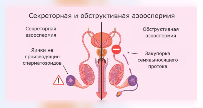 Азооспермия. Что это такое, лечится или нет