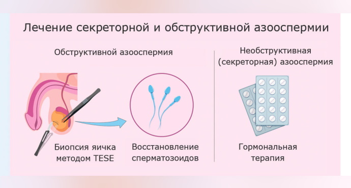Азооспермия. Что это такое, лечится или нет