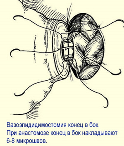 Азооспермия. Что это такое, лечится или нет