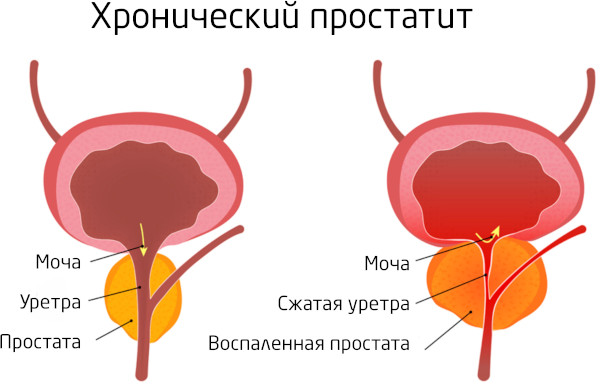 Бактериальный хронический простатит. Симптомы, лечение