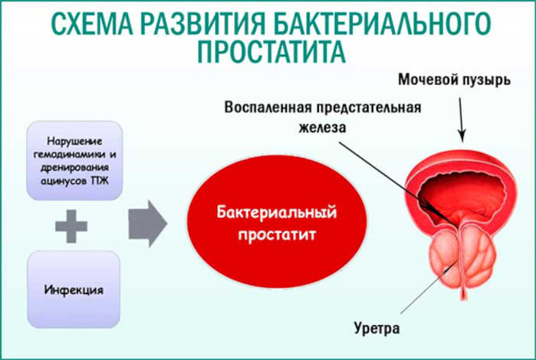 Бактериальный хронический простатит. Симптомы, лечение