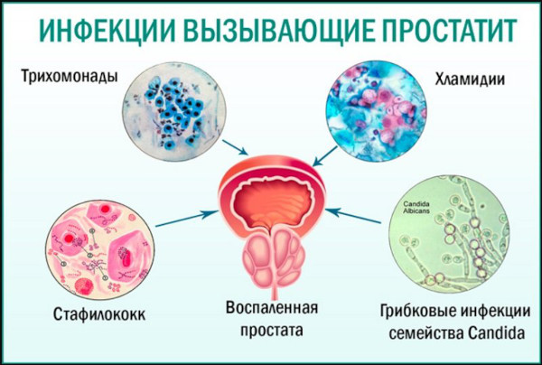 Бактериальный хронический простатит. Симптомы, лечение