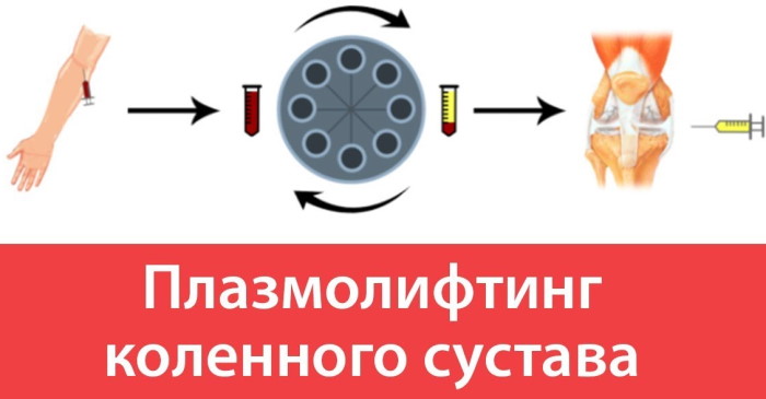Биоимпланты коленного сустава. Цена, отзывы