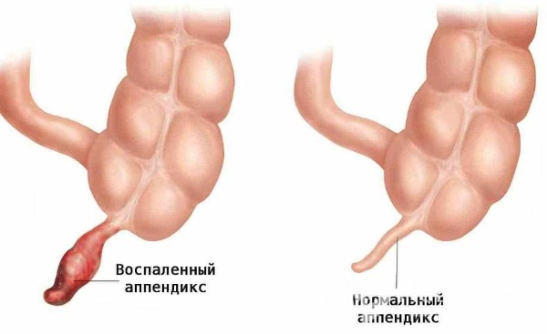 Боль паху у женщин слева, отдающая в бедро, ногу. Что это, ноющая, тупая, резкая, пульсирующая, колющая