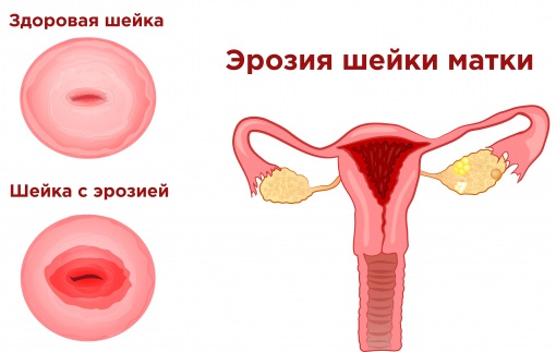 Боль паху у женщин слева, отдающая в бедро, ногу. Что это, ноющая, тупая, резкая, пульсирующая, колющая