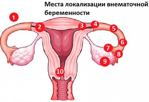 Спираль от беременности. Фото, виды, стоимость, как работает, как ставят