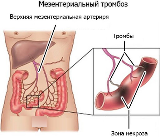 Боль в правой подвздошной области у женщин. Причины