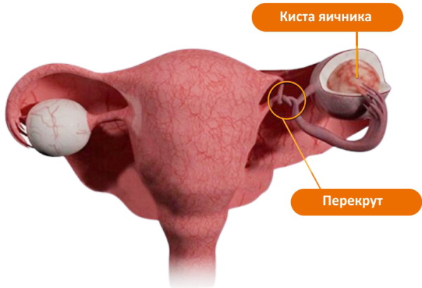 Боль в правой подвздошной области у женщин. Причины