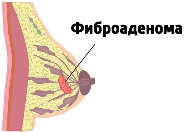 Боль в сосках у женщин. От чего болят соски, в области соска