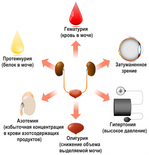 Болезнь Берже у детей. Клинические рекомендации