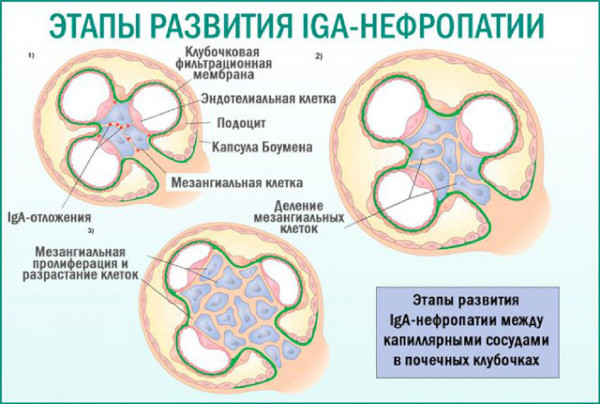 Болезнь Берже у детей. Клинические рекомендации