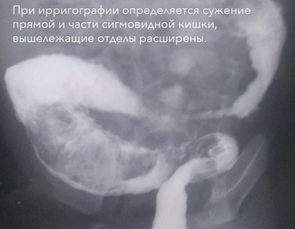 Болезнь Гиршпрунга у детей. Рентген, лечение