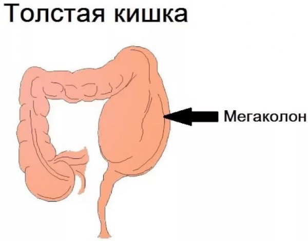 Болезнь Гиршпрунга у детей. Рентген, лечение