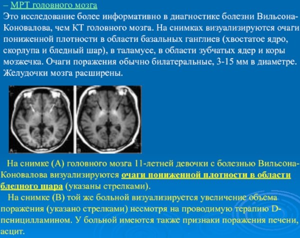 Болезнь Вильсона-Коновалова. Лечение, диагностика, клинические рекомендации