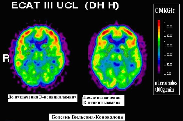 Болезнь Вильсона-Коновалова. Лечение, диагностика, клинические рекомендации