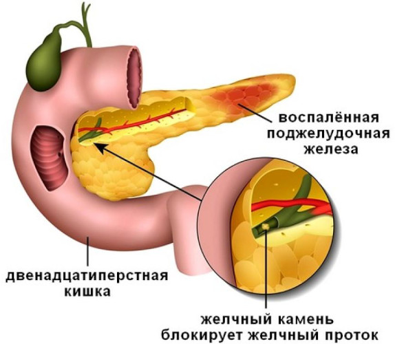 Болезненность молочных желез: жжение, покалывание, набухание. Причины